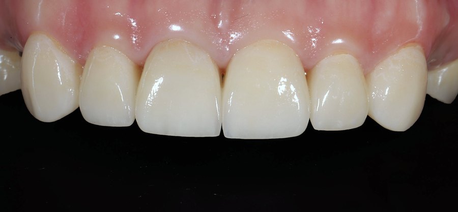 Après – Cas clinique du Docteur Victor Hazout : dents antérieures avant et après le remplacement des restaurations. Les anciennes présentaient des bords colorés au contact de la gencive. Photos ajustées en exposition, balance des blancs et netteté, de façon identique pour les deux images, sans modification du résultat.