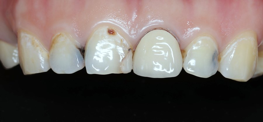 Avant – Cas clinique du Docteur Victor Hazout : dents antérieures avant et après le remplacement des restaurations. Les anciennes présentaient des bords colorés au contact de la gencive. Photos ajustées en exposition, balance des blancs et netteté, de façon identique pour les deux images, sans modification du résultat.