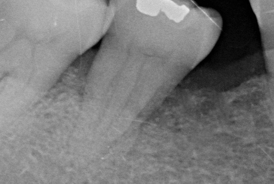 After · 2021 – Clinical case by Dr Victor Hazout. Bone defect along a lower molar: X-ray before treatment (2014), then seven years later (2021). The two images were not taken at exactly the same angle; the comparison is indicative.