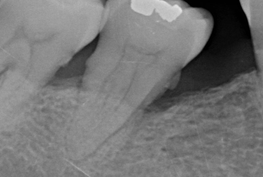 Before · 2014 – Clinical case by Dr Victor Hazout. Bone defect along a lower molar: X-ray before treatment (2014), then seven years later (2021). The two images were not taken at exactly the same angle; the comparison is indicative.