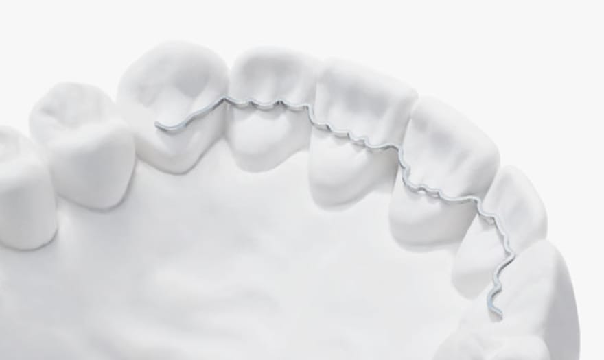 Illustration: a bonded splint joining loose teeth.