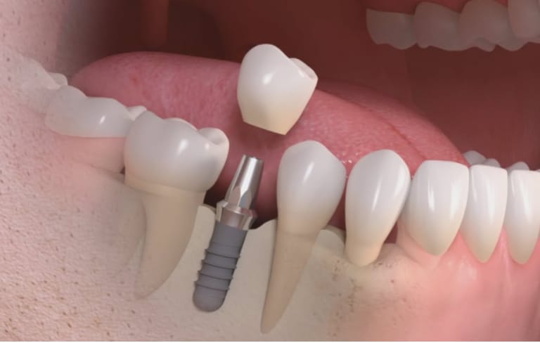 Illustration: an implant and its crown.