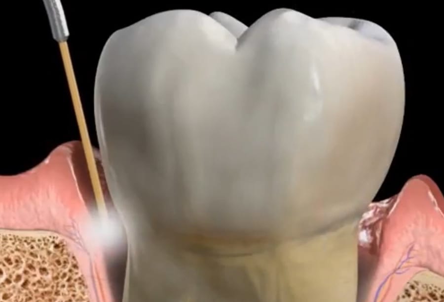 Illustration: how a laser acts on the tissues of the mouth.