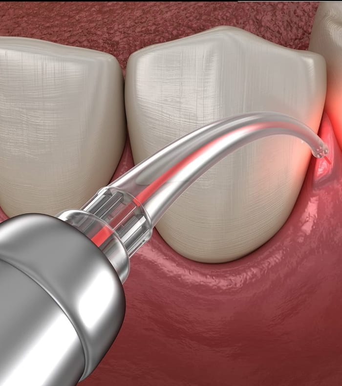 Illustration: laser handpiece directed at the gum.